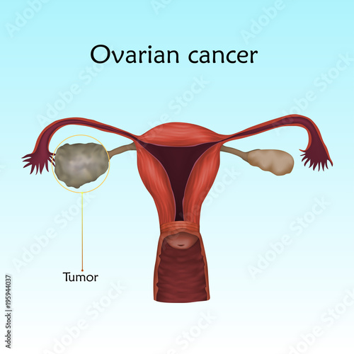 Ovarian cancer. Human realistic uterus. Anatomy illustration with specification. Colored image, blue background. Gynecological diseases.