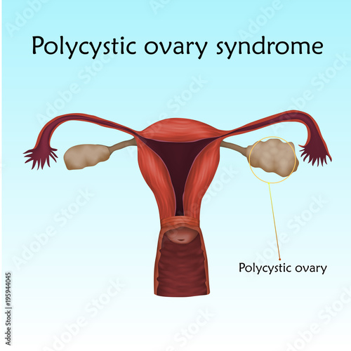 Polycystic ovary syndrome. Human realistic uterus. Anatomy illustration with specification. Colored image, blue background. Gynecological diseases.