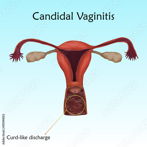 Candidal Vaginitis. Human realistic uterus. Anatomy illustration with specification. Colored image, blue background. Gynecological diseases.
