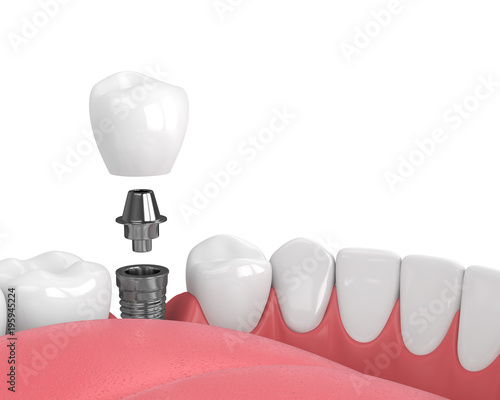 3d render of jaw with teeth and dental premolar implant