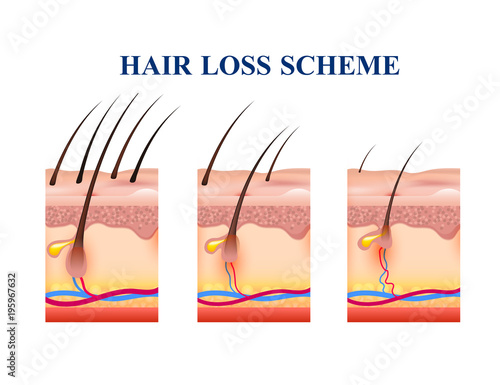 Hair Loss Scheme