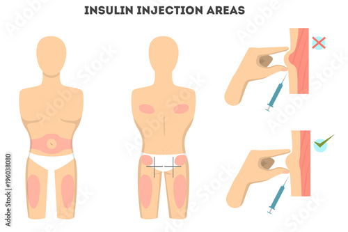 Insulin injections places.