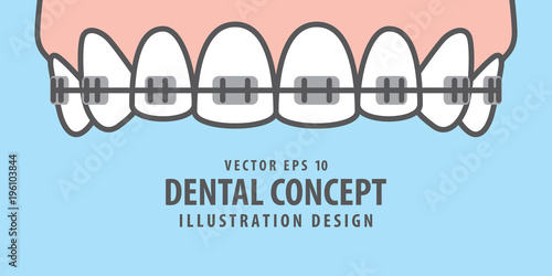 Banner Upper Braces teeth illustration vector on blue background. Dental concept.