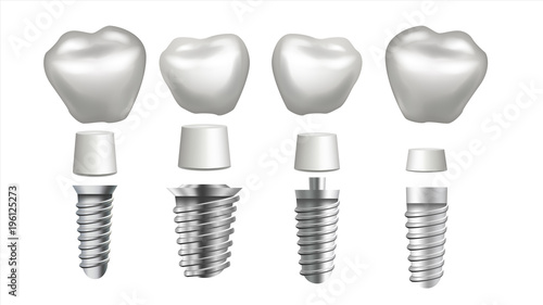 Dental Implant Set Vector. Tooth Set. Dental Health. Stomatology Dentistry. Whitening Design. Realistic Isolated Illustration