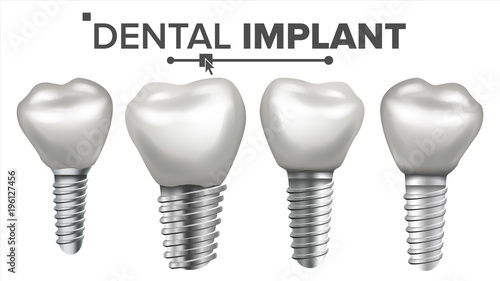Dental Implant Set Vector. Implant Structure. Crown, Abutment, Screw. Care, Stomatology. Realistic Isolated Illustration