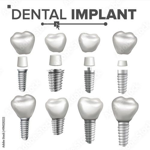 Dental Implant Set Vector. Dental Clinic Stomatology Flyer. Health Tooth Implant. Realistic Isolated Illustration