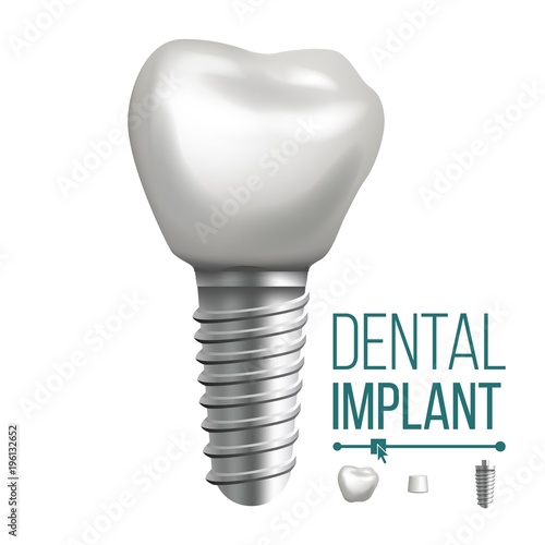 Dental Implant Vector. Molar Human Teeth. Dental Clinic Stomatology Flyer. Realistic Isolated Illustration
