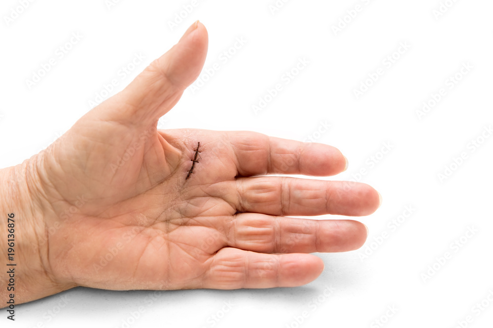 Hand mit Naht, Erkrankung Morbus Dupuytren oder Schnappfinger, schnellender Finger Hand mit Naht, Erkrankung Morbus Dupuytren oder Schnappfinger, schnellender Finger