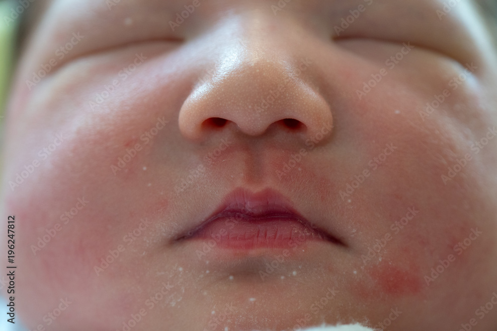 新生児の赤ちゃんニキビ Stock Photo Adobe Stock