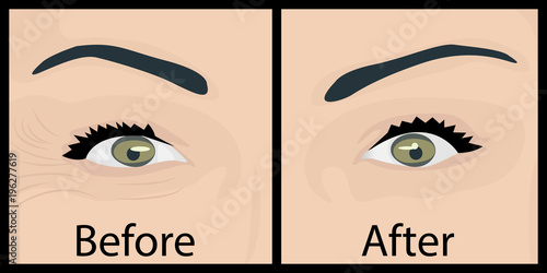Wrinkles and fine lines under eyes to remove. Before and After. Eyes lifting