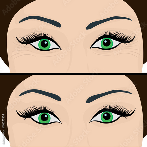 Wrinkles and fine lines under eyes to remove. Before and After. Eyes lifting