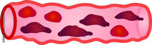 Unhealthy blood vessel