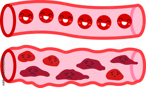 Healthy blood vessel and Unhealthy blood vessel 2