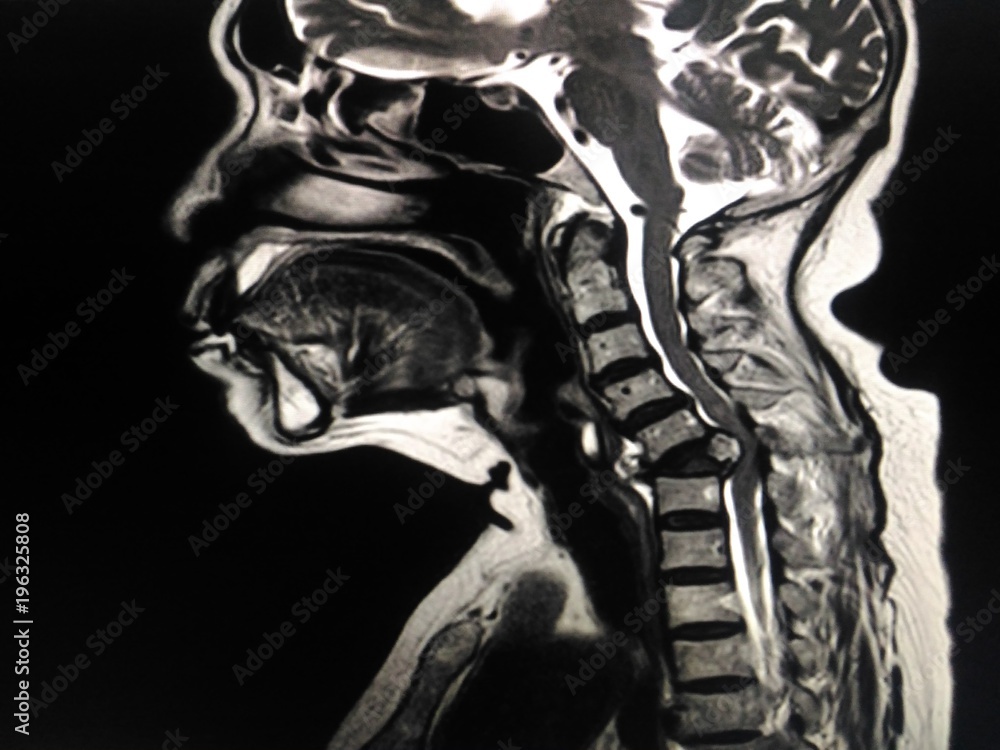 Foto de MRI.Cervical spine a human showing mass or tumor in bone neck