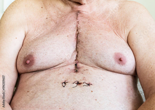 Surgical scar from cardiac surgery of coronary artery disease