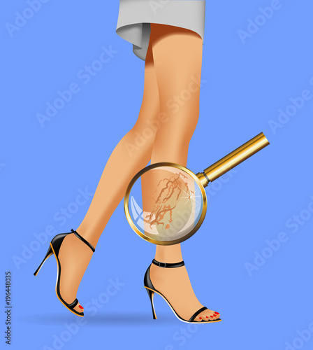 Female slim legs and varicose with health symbols vector realistic illustration