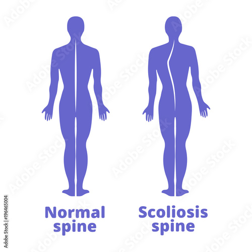 Disease of a spine. Scoliosis. Body posture defect. Blue human silhouettes isolated. Vector illustration.
