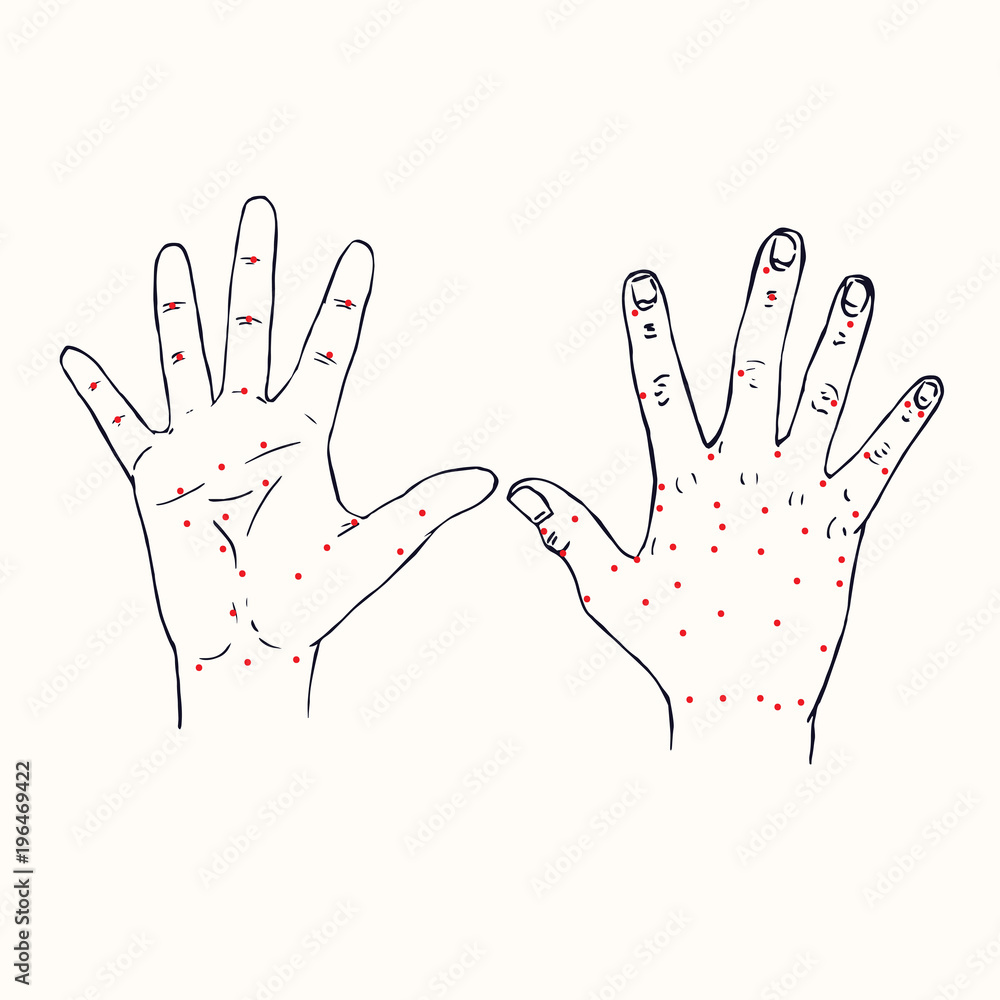 Hands (palm and dorsum of right hand) Chinese acupuncture scheme with red points, hand drawn doodle, sketch in pop art style, black and white medical vector illustration - obrazy, fototapety, plakaty 
