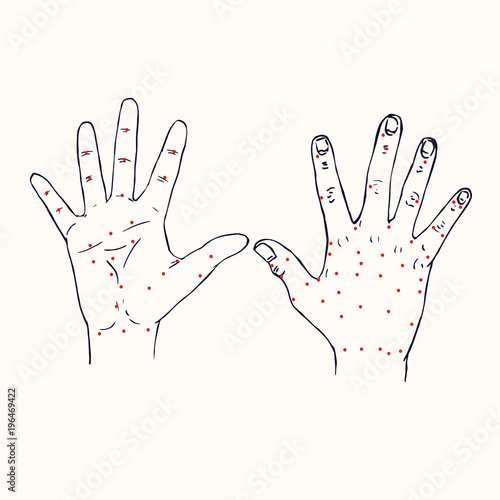 Wallpaper Mural Hands (palm and dorsum of right hand) Chinese acupuncture scheme with red points, hand drawn doodle, sketch in pop art style, black and white medical vector illustration Torontodigital.ca