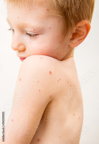 child with varicella