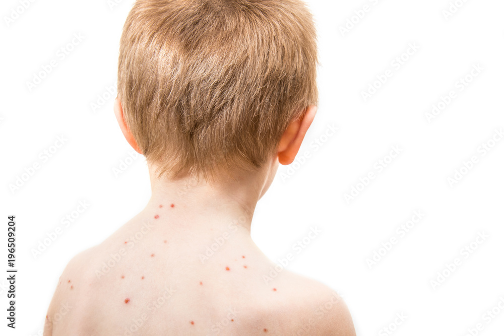 Naklejka premium child with varicella