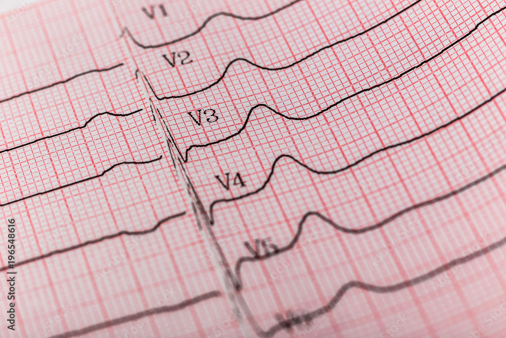 Analysis and Interpretation of the Electrocardiogram Analysis and Interpretation of the Electrocardiogram
