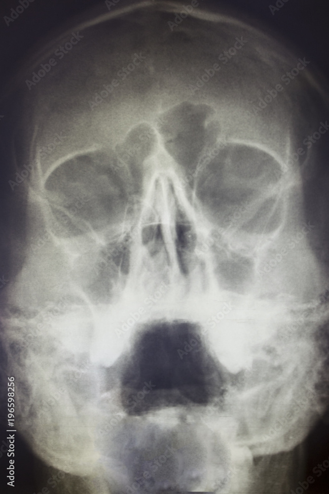 X-ray image or X-ray of the human skull, close-up. X-ray image or X-ray of the human skull, close-up.