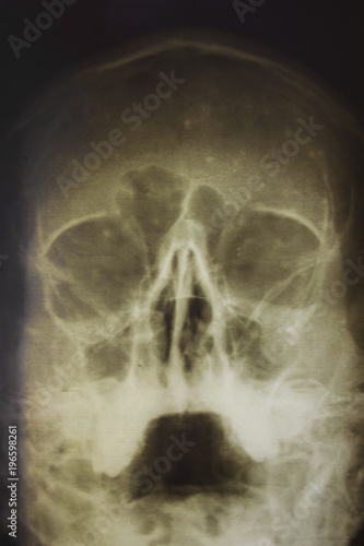 X-ray image or X-ray of the human skull, close-up.