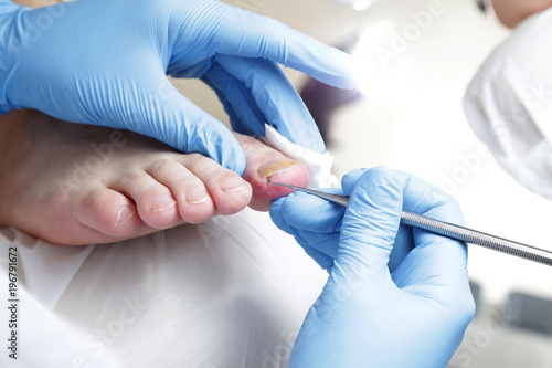 Wrastający paznokieć. Podologia