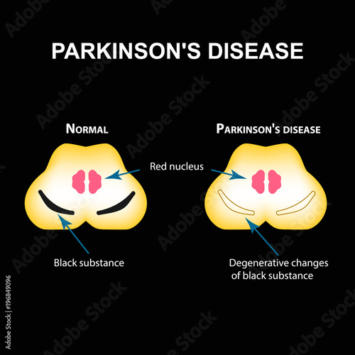 Parkinson's disease. Degenerative changes in the brain are a black substance. Vector illustration on black background.