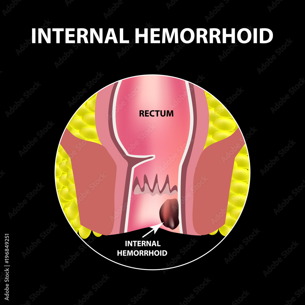 Hemorrhoids internal. Rectum structure. Intestines. colon. Internal