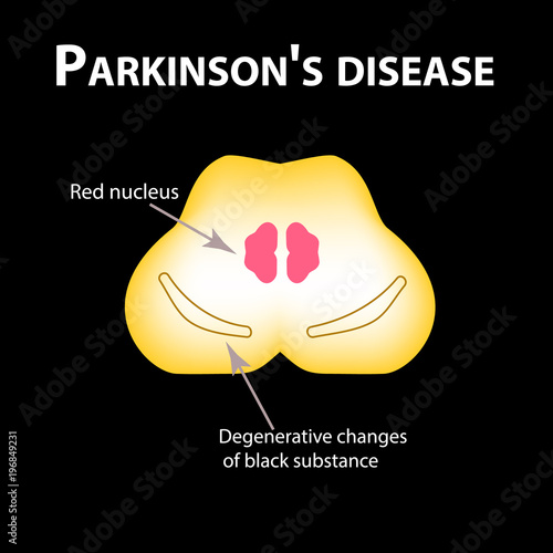 Parkinson's disease. Degenerative changes in the brain are a black substance. Vector illustration on black background.