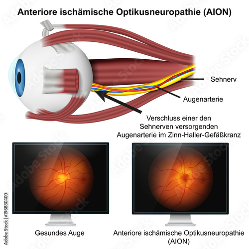 Anteriore ischämische Optikusneuropathie , AION mit Bild vom Augenhintergrund