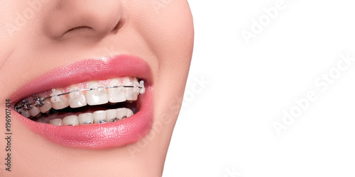 Braces on Teeth. Dental Braces Smile. Orthodontic Treatment. Closeup Smiling Face with Braces. Isolated on White Background.. photo