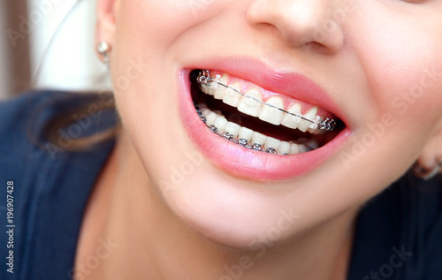 Zbliżenie żeński uśmiech z ceramicznymi nawiasów klamrowych zębami. Leczenie ortodontyczne.