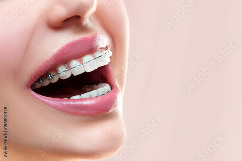 Close up open mouth with Ceramic and Metal Braces on beautiful Teeth. Broad Smile with Self-ligating Brackets. Orthodontic Treatment. Woman Smiling Showing Dental Braces..