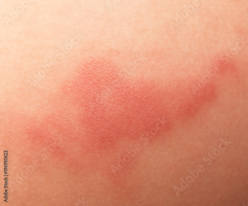 redness on baby skin
