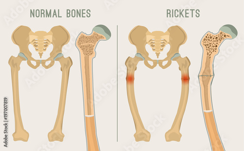 Vector Rickets Scheme