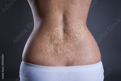 Fotografie Woman with a large scar after burn on the back