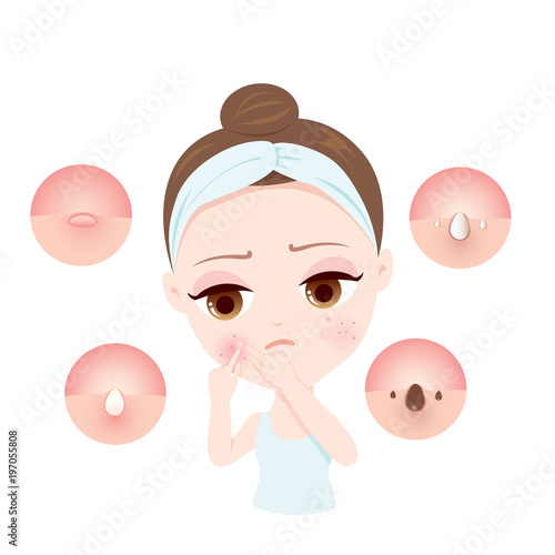 Type of Acne Women