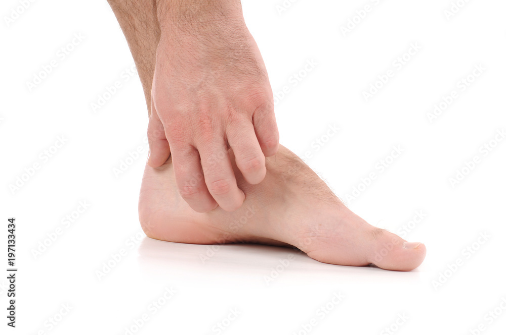 Man scratch the itch with hand. Infection of the feet caused by fungus.
