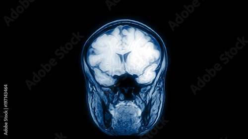 Computed medical tomography MRI upscaled scan of healthy young female head. Front view. Optically retimed for smooth motion. Blue/teal on black background.