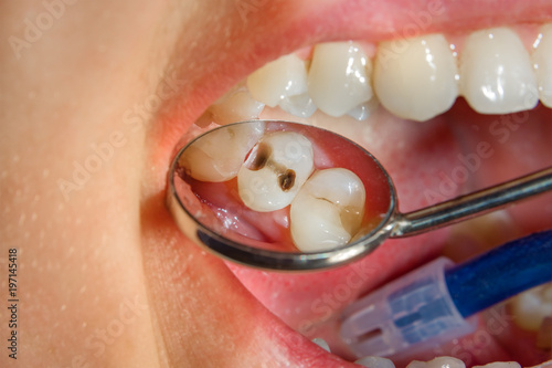 Wall Mural Dental treatment in dental clinic