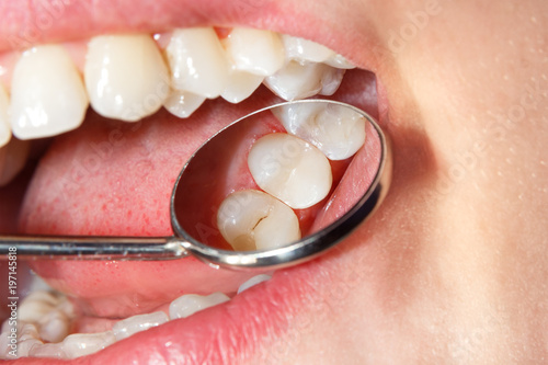 Dental treatment in dental clinic. Rotten carious tooth macro. Treatment endodontic canals