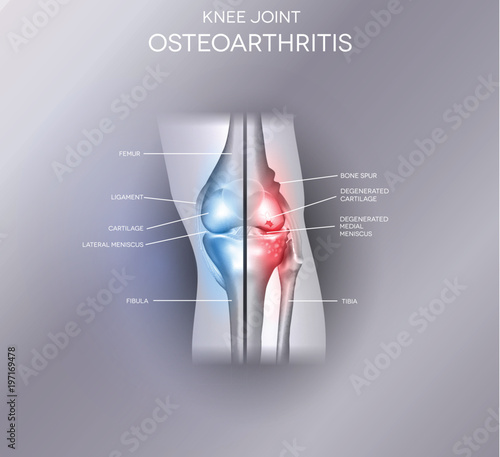 Damaged and healthy joint design. Part of the joint normal and other part damaged on an abstract grey background.