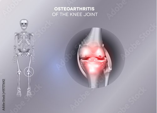Damaged joint on a grey background.