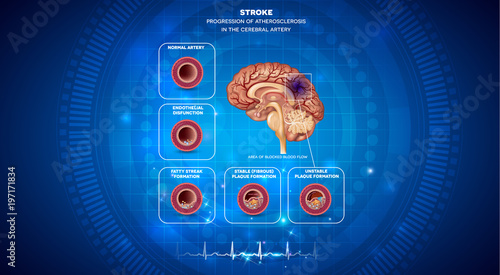Stroke, blood clot formation in the brain artery, brain damage. Abstract blue technology background with cardiogram.