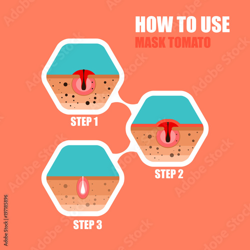 Modern vector illustration of skin problems. Dark dots, acne. Fa