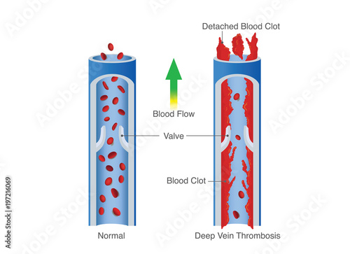 Medical Diagram of Deep Vein Thrombosis. Illustration about abnormally of blood floow.