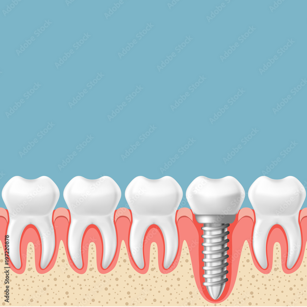 Row of teeth with dental implant - teeth prosthetics scheme, gum cut Row of teeth with dental implant - teeth prosthetics scheme, gum cut
